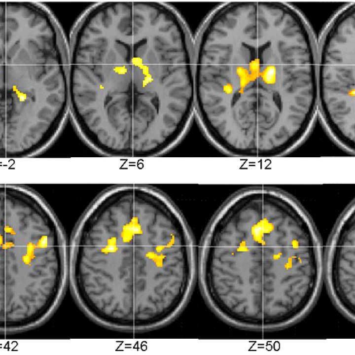 Talking Therapy Changes the Brain's Wiring