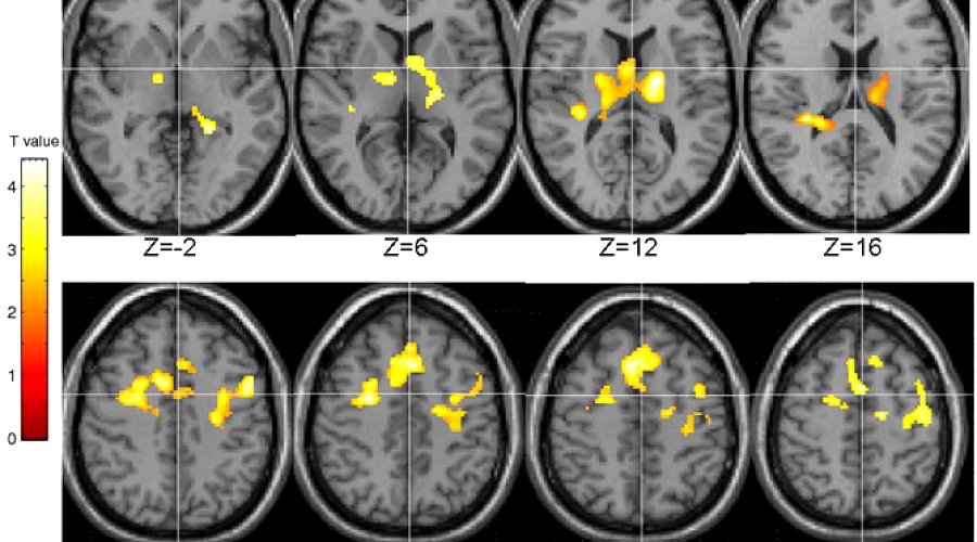 Talking Therapy Changes the Brain's Wiring